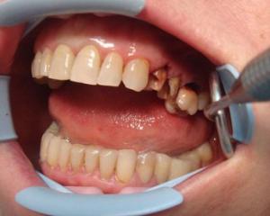 Гранулема на корне зуба - лечение, фото
