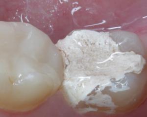 Лечение зубов с мышьяком или под анестезией