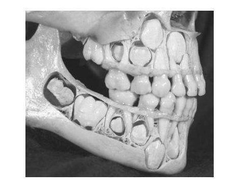 Фото трпипофобии – череп ребенка с невыпавшими молочными зубами