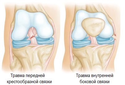 Разрыв связок колена