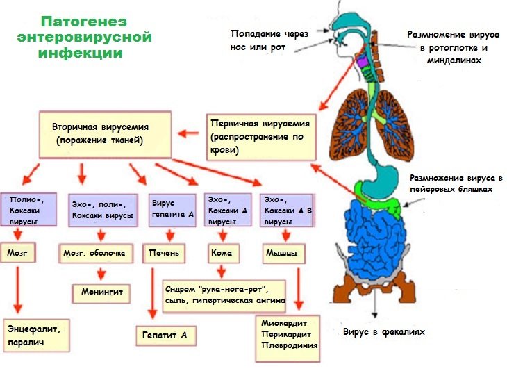 Схема патогенеза энтеровирусной инфекции