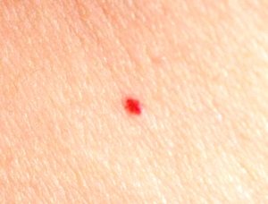 Красная точка на теле