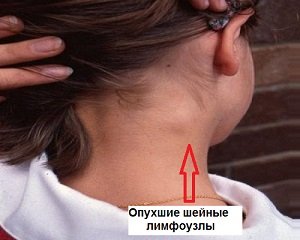 Увеличение лимфоузлов на шее