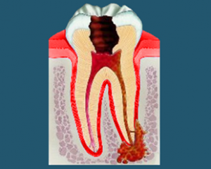 Киста на корне зуба - фото, причины, лечение