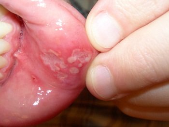 Герпетический стоматит у ребенка на губе