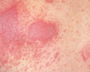 Аллергический дерматит: фото, симптомы и лечение у взрослых
