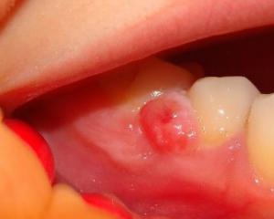 Киста на корне зуба - фото, причины, лечение