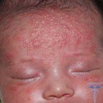 пищевая аллергия у новорожденных
