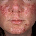 Как лечить угри на лице? Симптомы и причины.