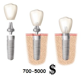Цена за протезирование одного зуба при помощи импланта
