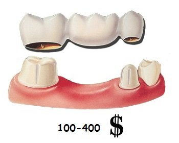 Цена за один зуб при установке мостовидного протеза