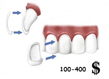 Цена за протезирование одного зуба при помощи виниров и люминиров