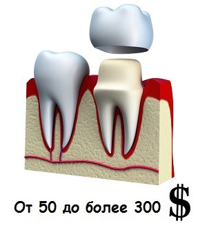 Цена за один зуб при установке зубной коронки