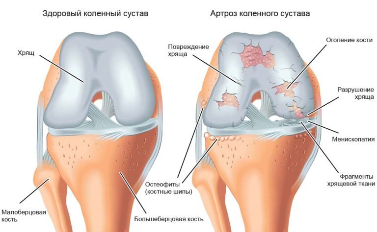 Артроз коленного сустава-лечение лопухом Артроз коленного сустава-лечение лопухом
