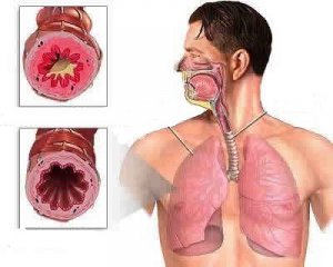 Чем лечить сухой кашель у взрослых