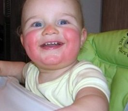 Диатез на щеках у ребенка - лечение, фото