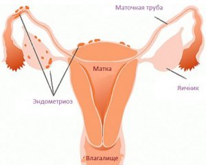 Эндометриоз матки - симптомы и лечение