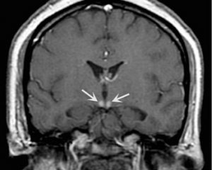 Энцефалопатия головного мозга - симптомы, лечение