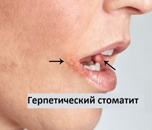 Лечение герпетического стоматита