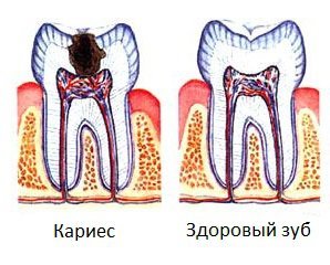 Карієс: фото, причини, лікування та профілактика карієсу на зубах