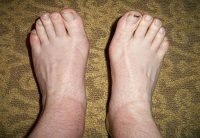 Припухлость ног при плоскостопии