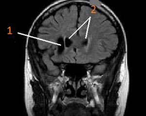 Киста головного мозга - симптомы и лечение
