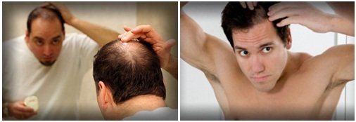 Потеря волос при заболевании щитовидной железы у мужчин 
