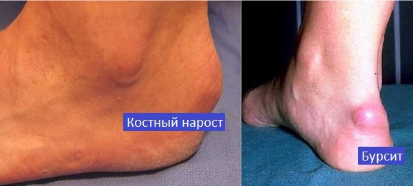 Наружное проявление бурсита и отличие от других заболеваний