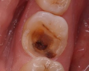 Причины, симптомы и лечение пульпита зуба