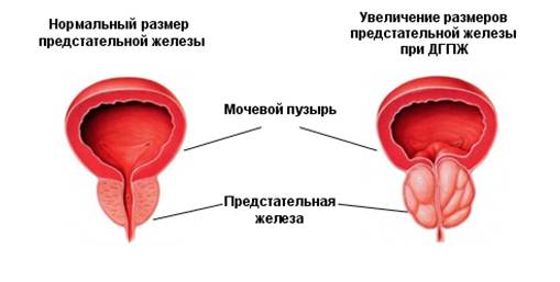 предстательной железы в норме и при аденоме простаты