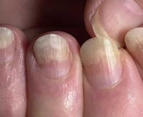 Как лечить грибок ногтей на руках