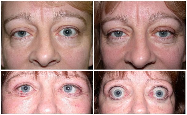 Выпучивания глаз (экзофтальма) у женщин