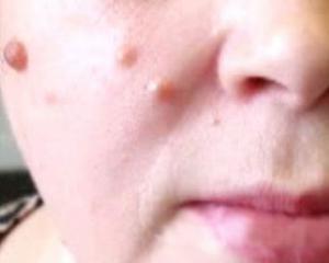 Бородавки на лице - причины и лечение, фото