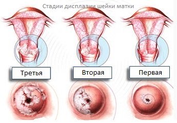Дисплазия шейки матки 1, 2, 3 степени