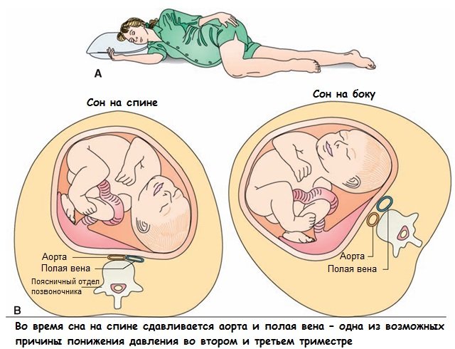 Сон на спине – причина понижения беременности во втором и третьем триместре