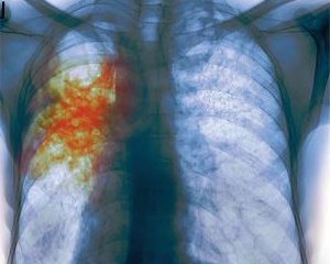 Туберкулез - симптомы и первые признаки