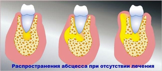 Осложнение зубного флюса (периостита)