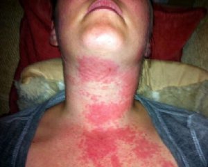 Аллергия: симптомы у взрослых, признаки и лечение