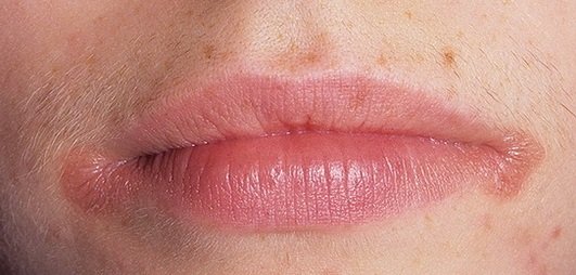 Как лечить заеды в уголках рта?