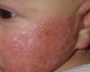 Пищевая аллергия: симптомы у взрослых и детей, лечение