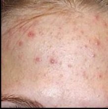 Клещ демодекс - фото, симптомы и лечение на лице