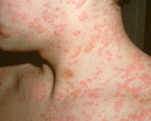 Аллергия: симптомы у взрослых, признаки и лечение