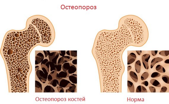 Остеопороз - симптомы и лечение