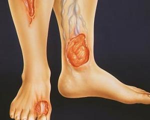 Трофическая язва на ноге - фото, симптомы и лечение