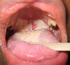 Грибковые инфекции в горле