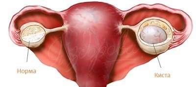 Киста яичника - симптомы и лечение у женщин
