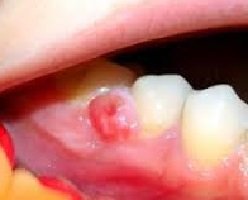 Гранулема на корне зуба - лечение, фото