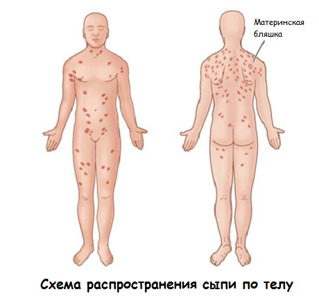 Схема распространения сыпи по телу
