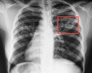 Туберкулез - симптомы и первые признаки