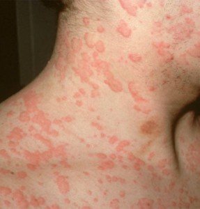 симптомы аллергии
